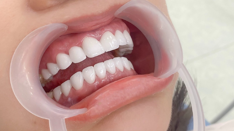 Chăm sóc răng sứ đúng cách – Bí quyết ngăn ngừa hôi miệng hiệu quả