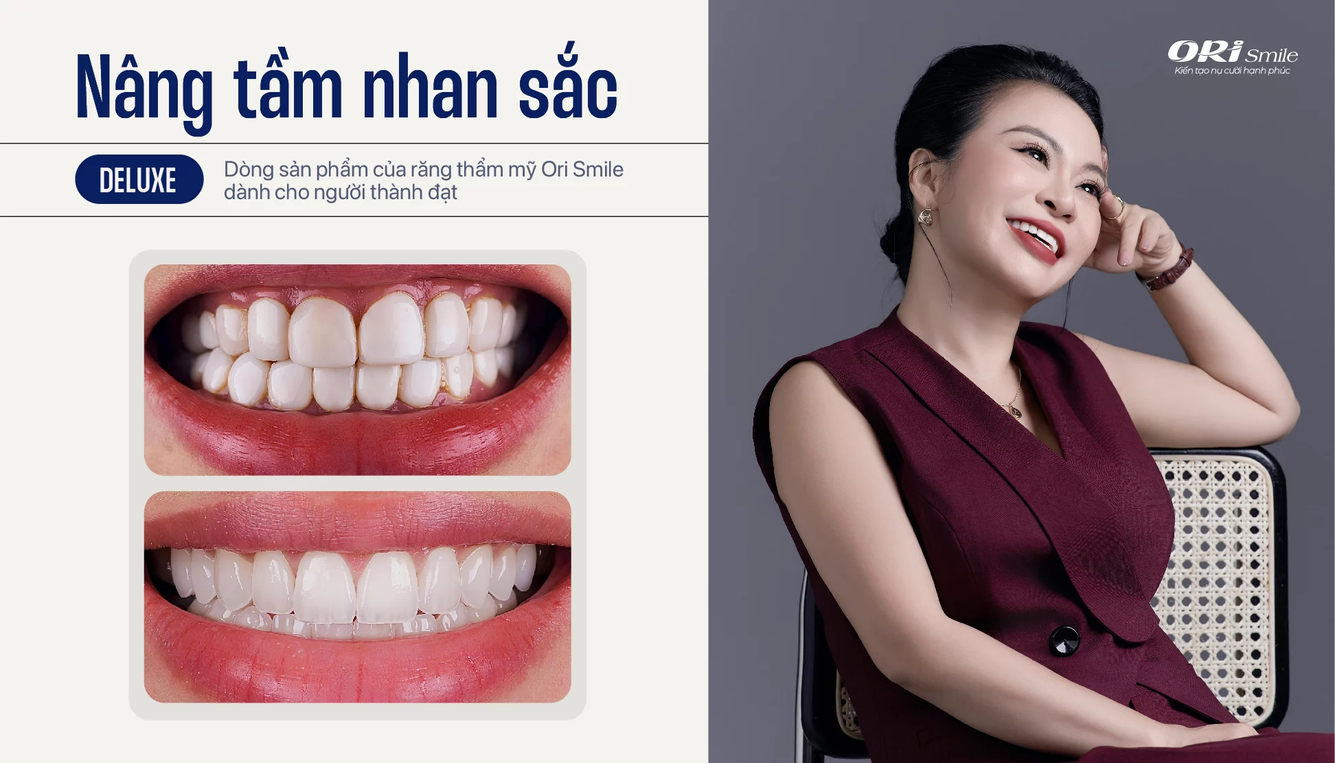 Hình ảnh trụ Implant Straumann và răng sứ